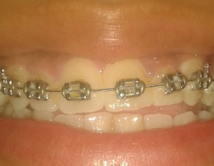 Open-Bite, Midline Misalignment