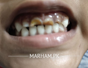 Teeth Growth Problem In 5 Years Old