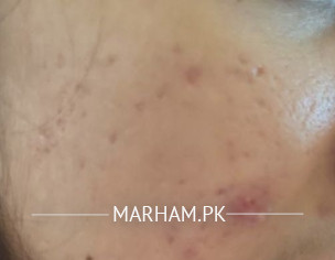 Skin Issue From Last 5years 