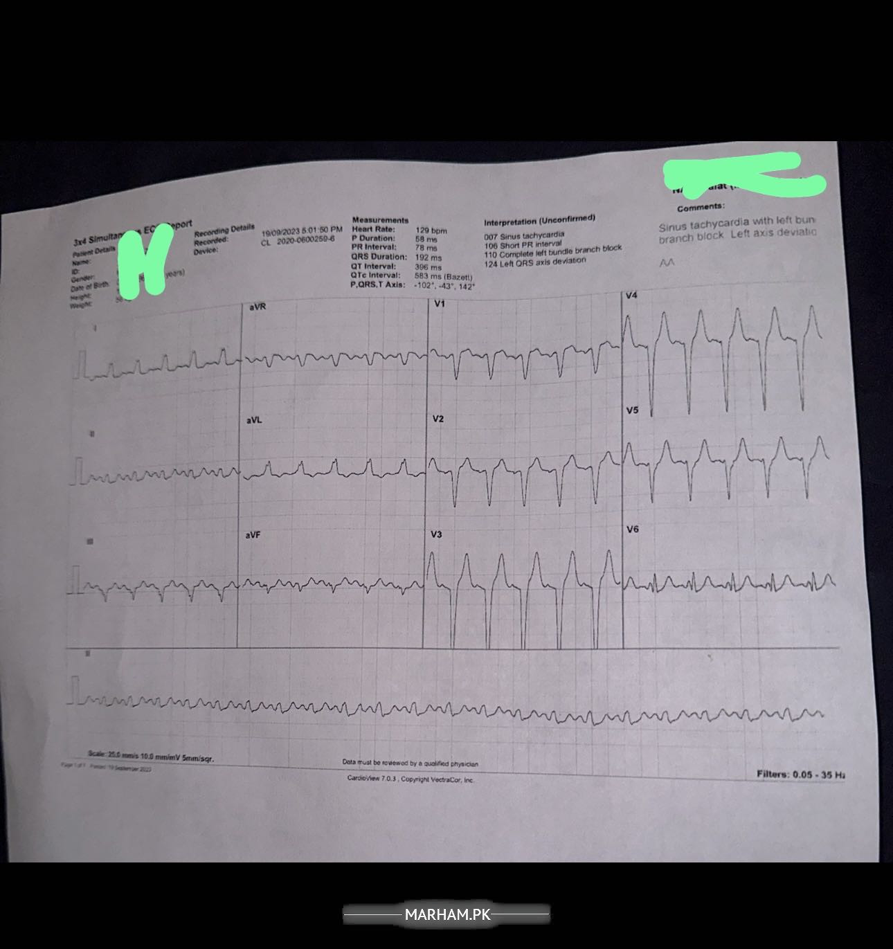 Ask a Cardiologist Online for Heart Rate