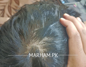 Hairs Issue