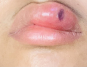 Swollen Lip