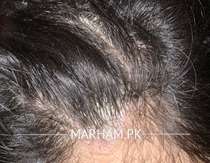 Buildup On Scalp