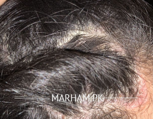 Buildup On Scalp