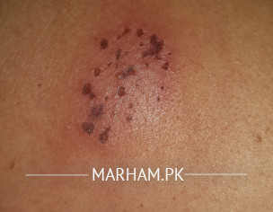 Localized Wound Type Appearance