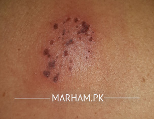 Localized Wound Type Appearance