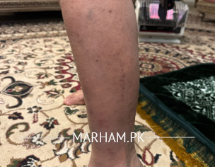 Extreme Allergy / Body Itching 