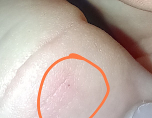 Possible Cat Scratch And Anxiety