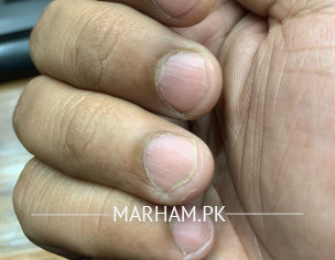Nail Problem