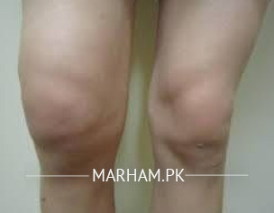 Knee Swelling Can't Bend