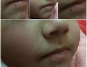 Dark Maroon Spot On Lower Lip