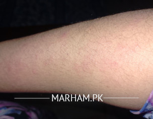 Itching In Hands And Legs