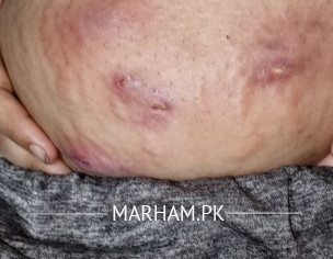 Pus Filled On Stomach