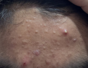 Pimples On Forhead