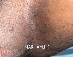 Inner Pimples After Jock Ich