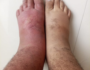 Swollen Leg