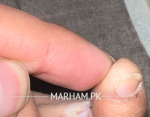 Skin Peeling Between Pinky Toe