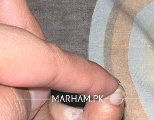 Skin Peeling Between Pinky Toe