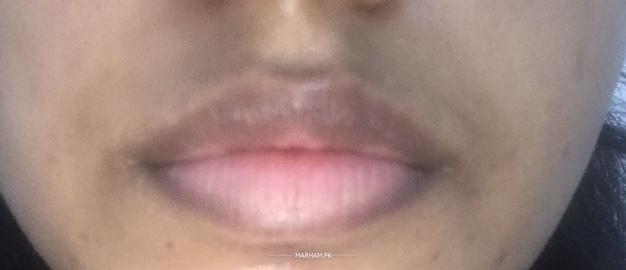 Ask a Dermatologist Online for Dark Lip And Around Area