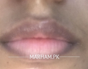 Dark Lip And Around Area