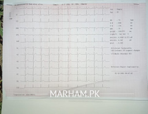 ECG Issue