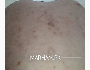 Back Acne