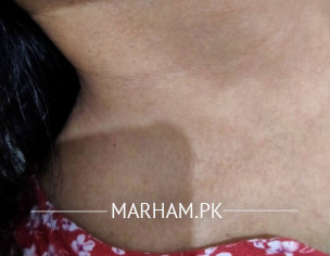 Pigmentation On Skin