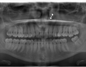 Cavity In Teeth