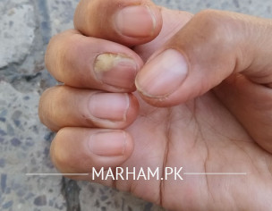 Broken Nails