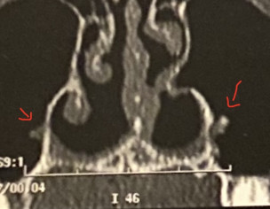 Pain After Multiple Rhinoseptoplasty