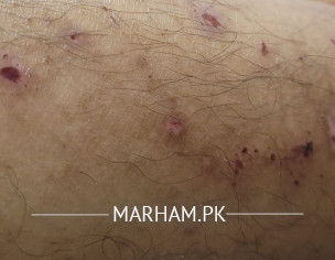 Extreme Skin Itching During Pregnancy