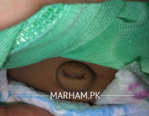 Navel Issue