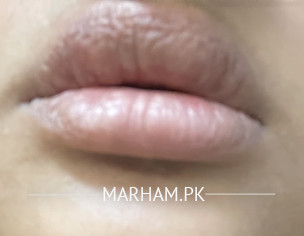 Swollen Lips And Lower Eyelid