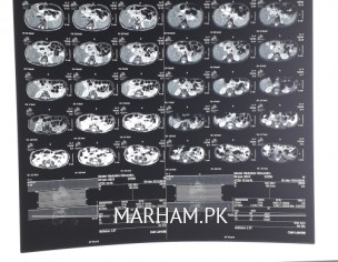 Cholydochal Cyst Type