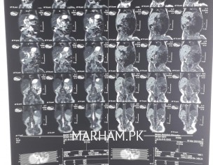 Cholydochal Cyst Type
