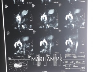 Cholydochal Cyst Type