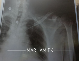 Shoulder Neck Head Light Blur Version