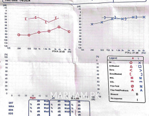 Hearing Loss From One Side