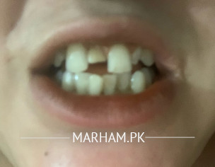 Teeth Problem 