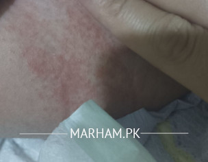 Skin Problem