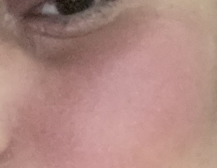 Skin Problem On Only Left Side Face