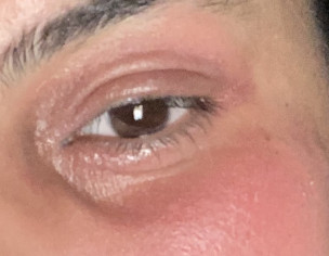 Skin Problem On Only Left Side Face