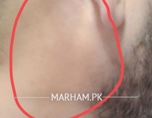 Neck Near Ear
