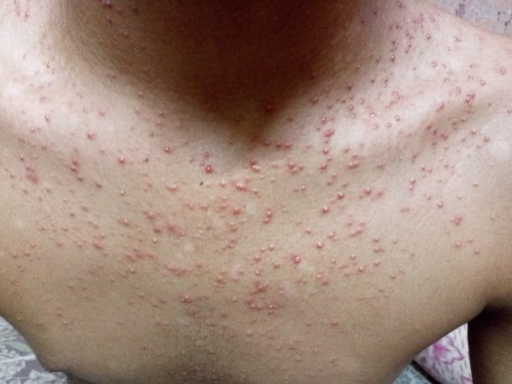 body acne