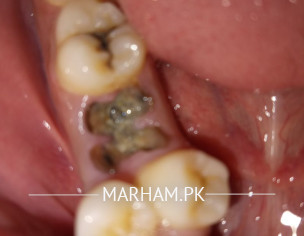 Teeth Replacement Or Braces
