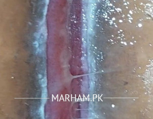 White Tissues Around Wound !!