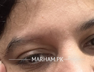 Eyebrow Loss