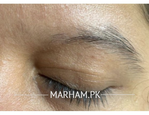 Eyebrow Loss