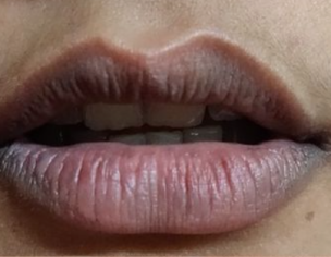 Mild Hyper Pigmentation Around Mouth