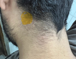 Pea Sized Bump On Left Side Of Neck